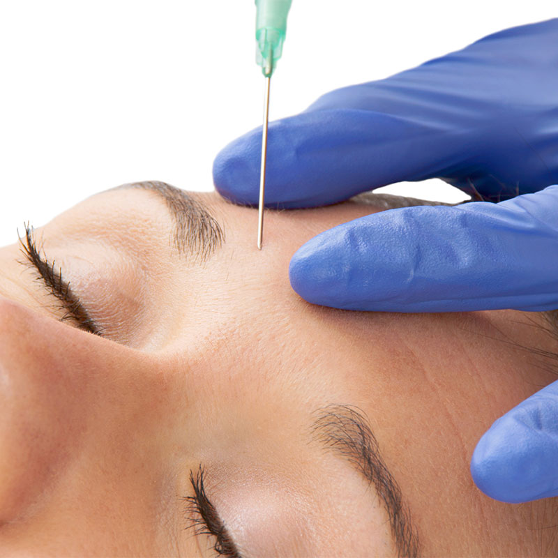Botox treatment of the forehead against expression lines at the Arkona Strandhotel on Rügen by medical specialists.
