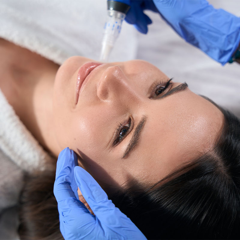 Close-up of a microneedling application on the face with DERMA PEN by ÄsthetikaMed in the Arkona Strandhotel on Rügen.